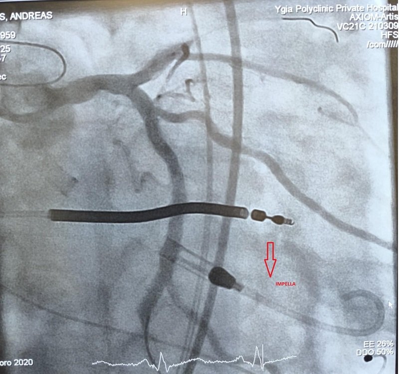 IMPELLA